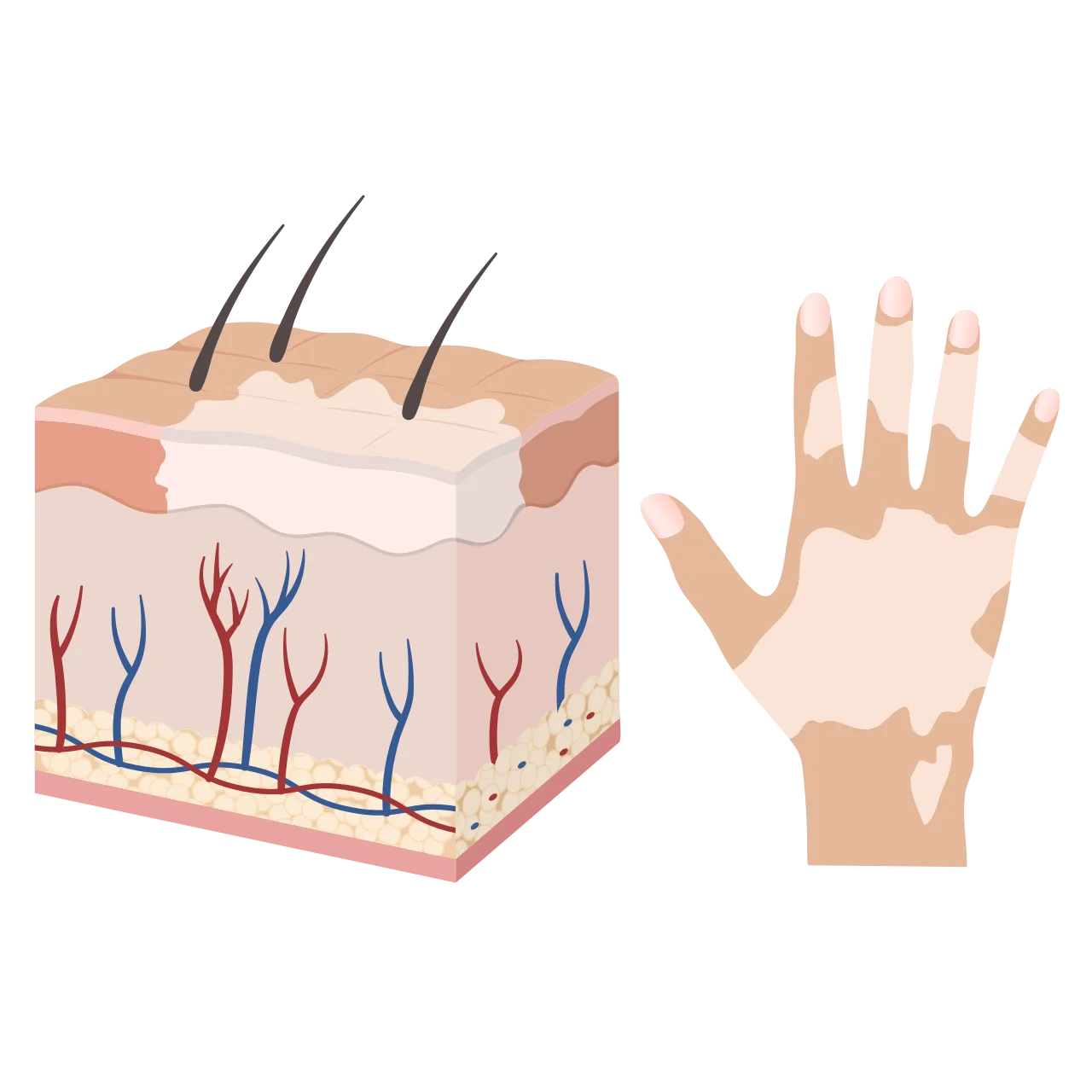 Vitiligo