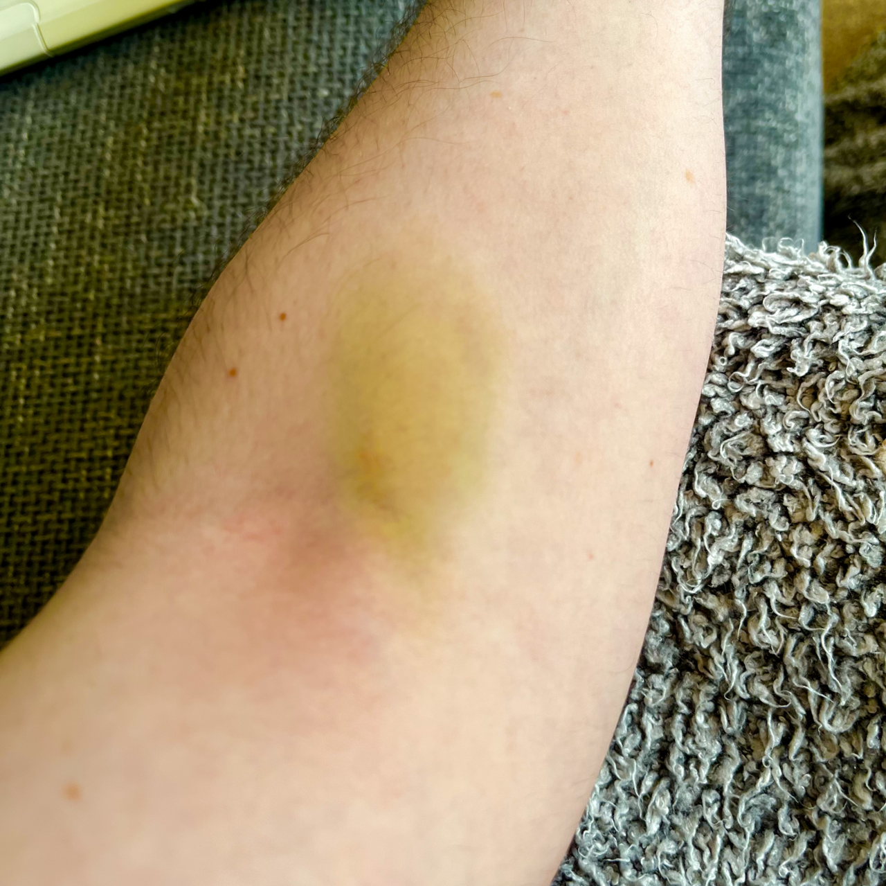 Bruise