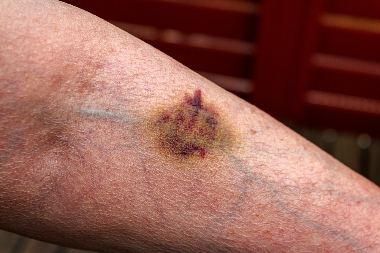 Bruise