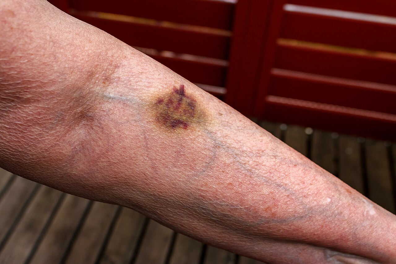 Bruise