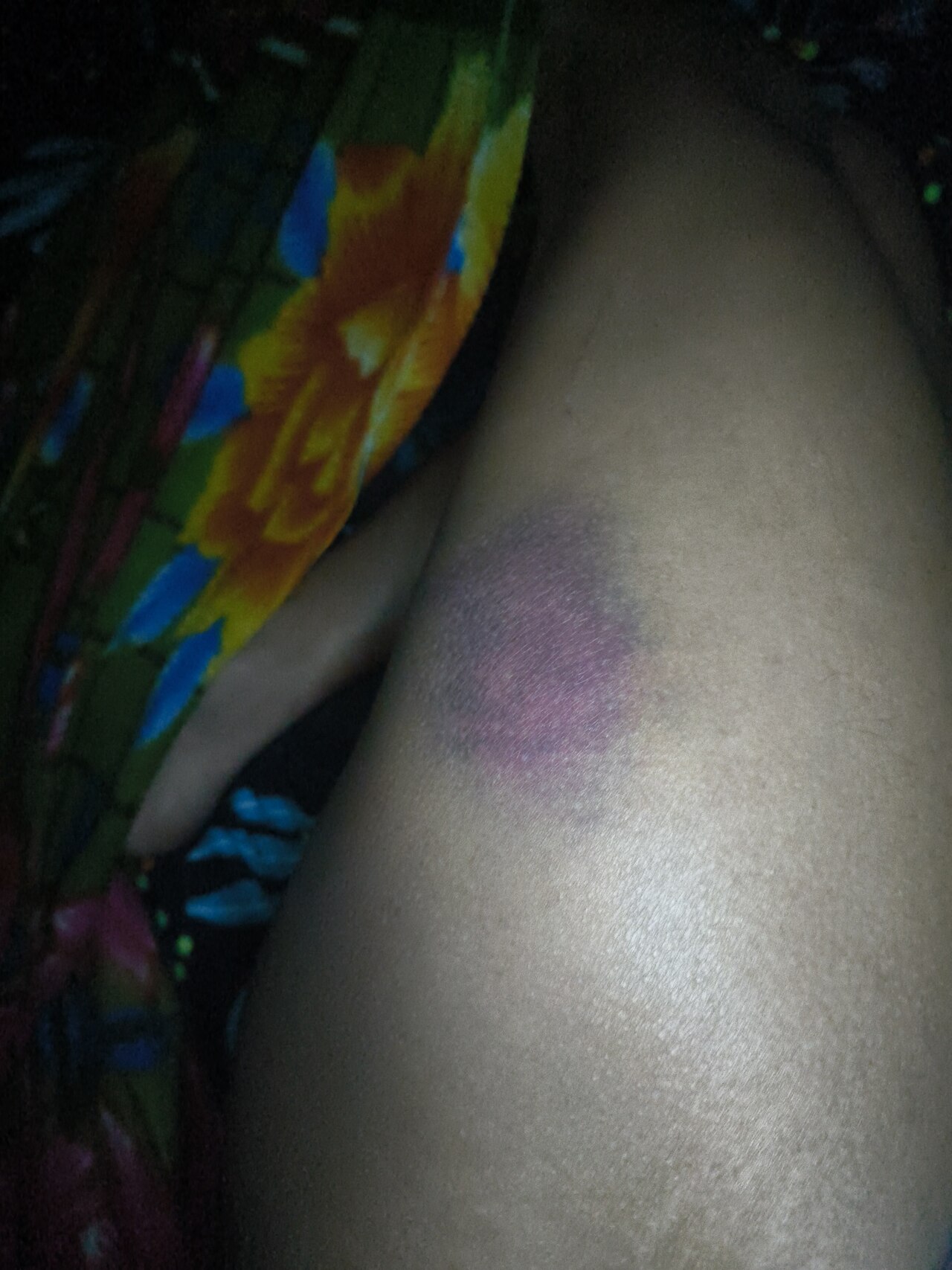 Bruise