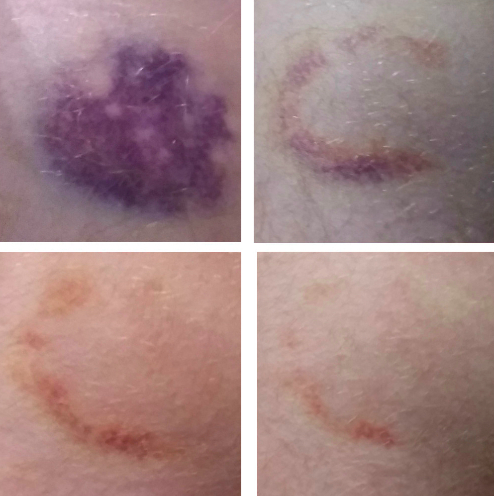 Bruise