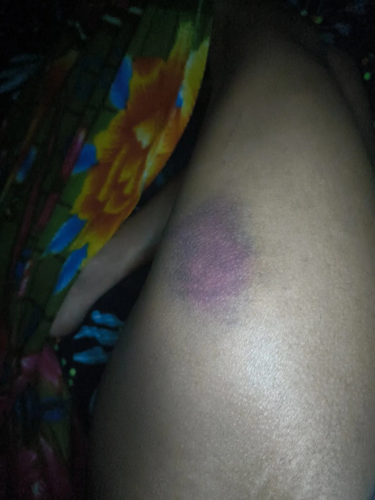 Bruise