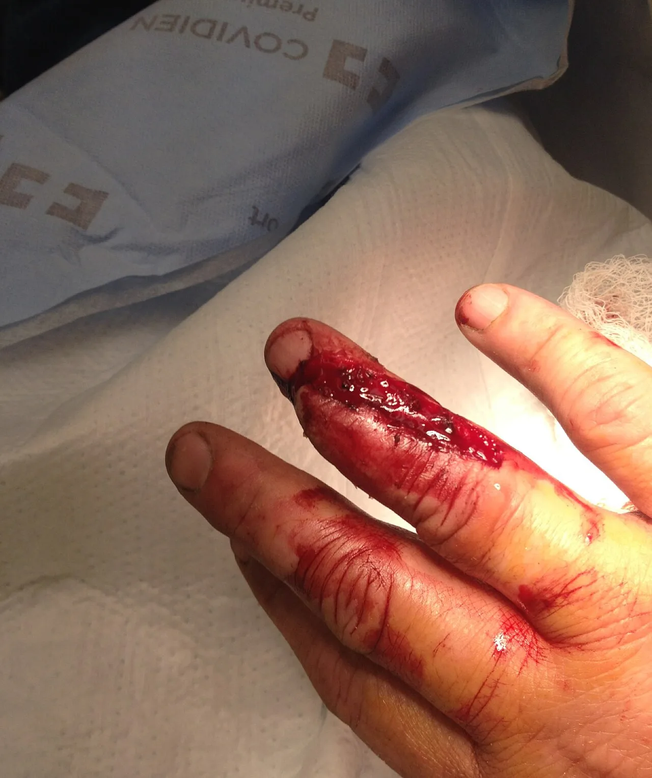 Crush injury