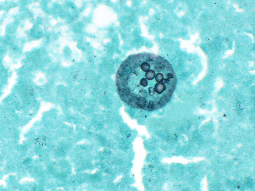 Coccidioidomycosis in lung, endospores in spherule