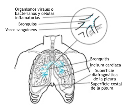 Acute (medicine)