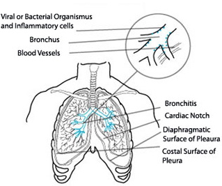 Acute (medicine)