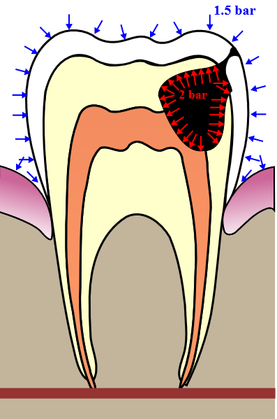 Barodontalgia