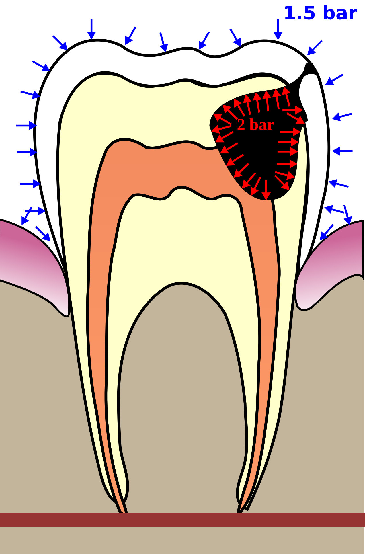 Barodontalgia