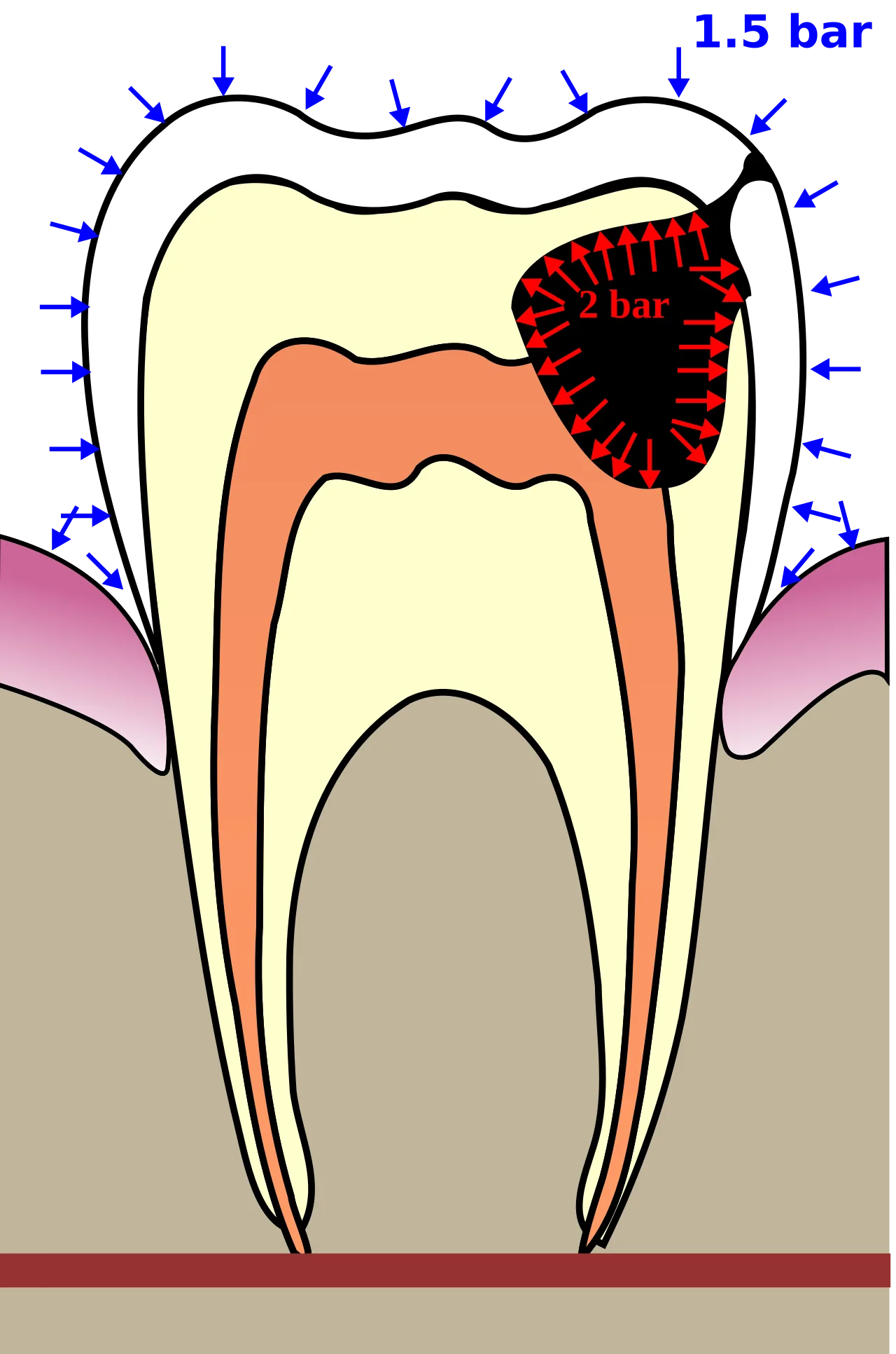 Barodontalgia