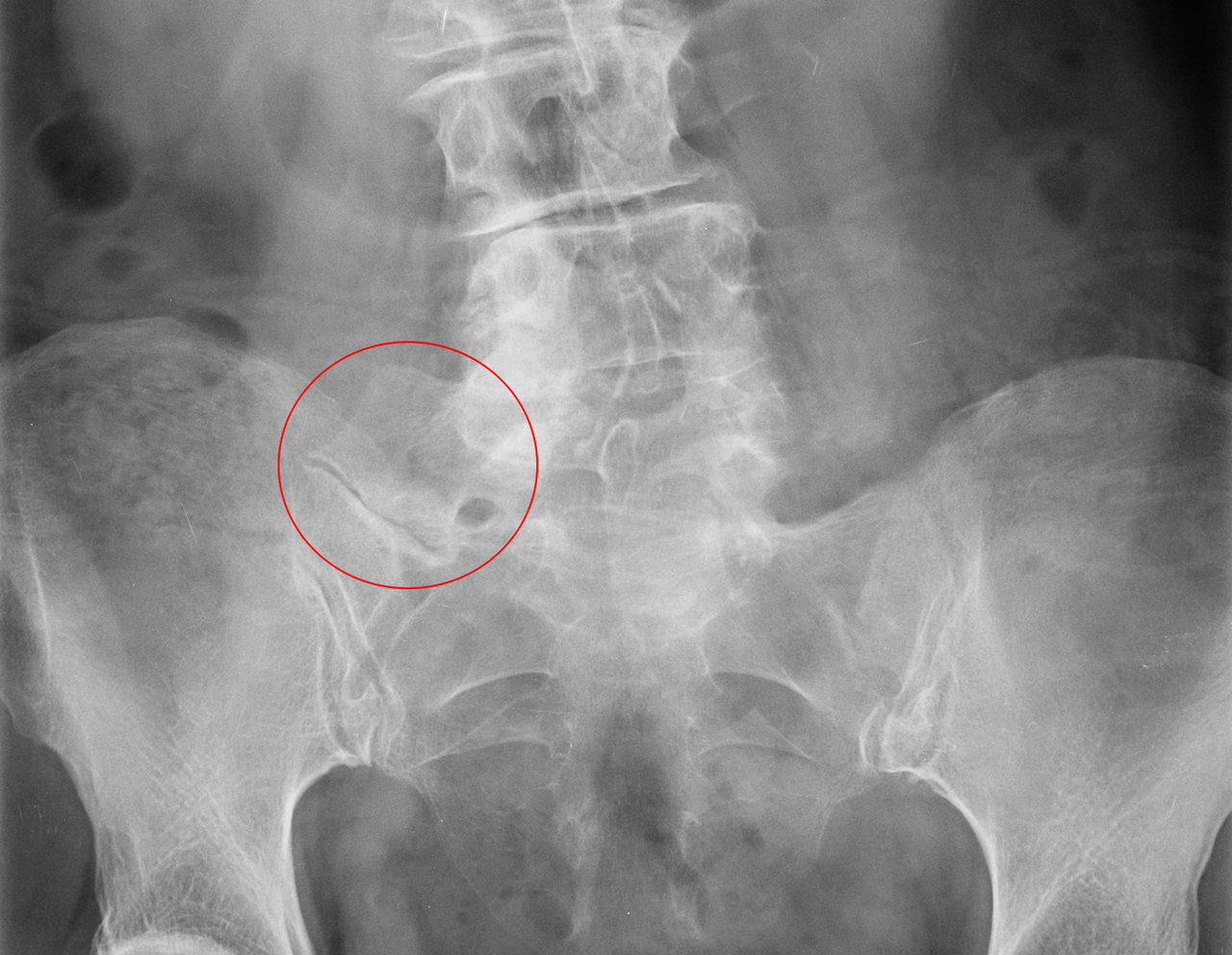 Bertolotti's syndrome