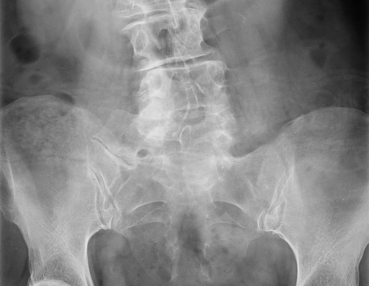 Bertolotti's syndrome