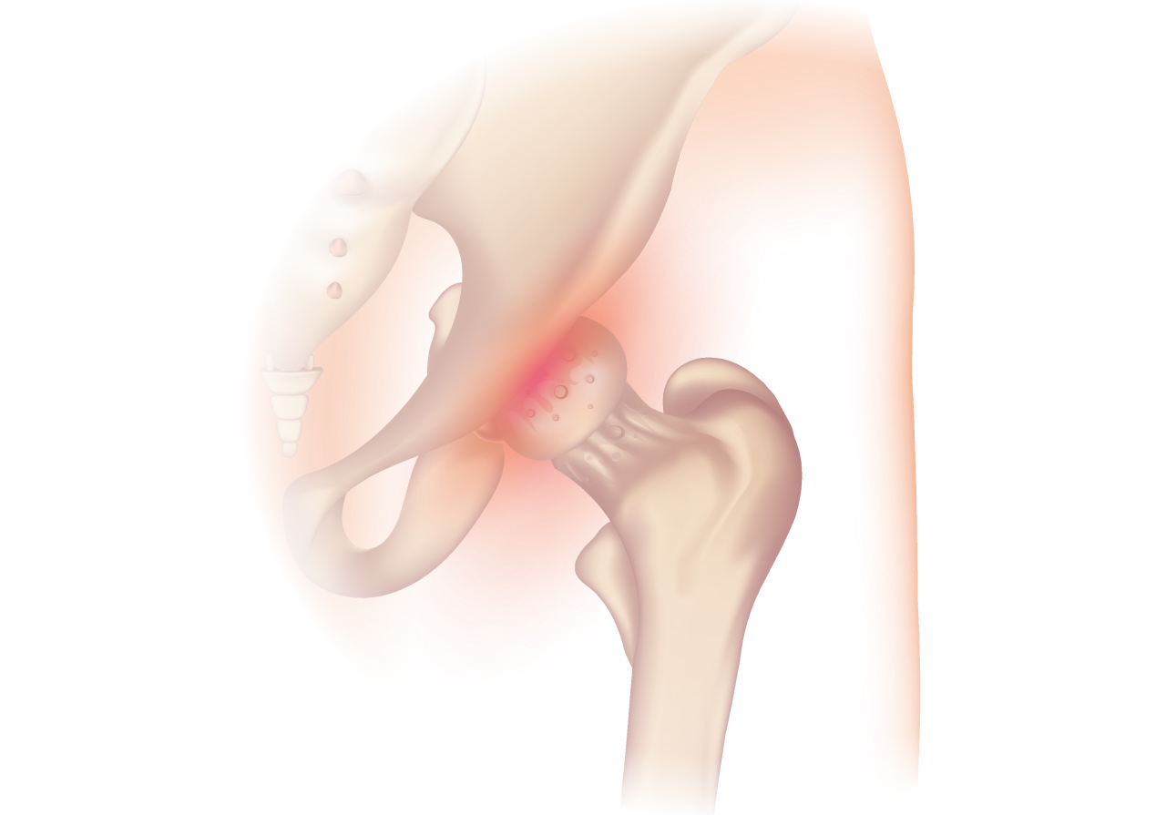 Bone pain