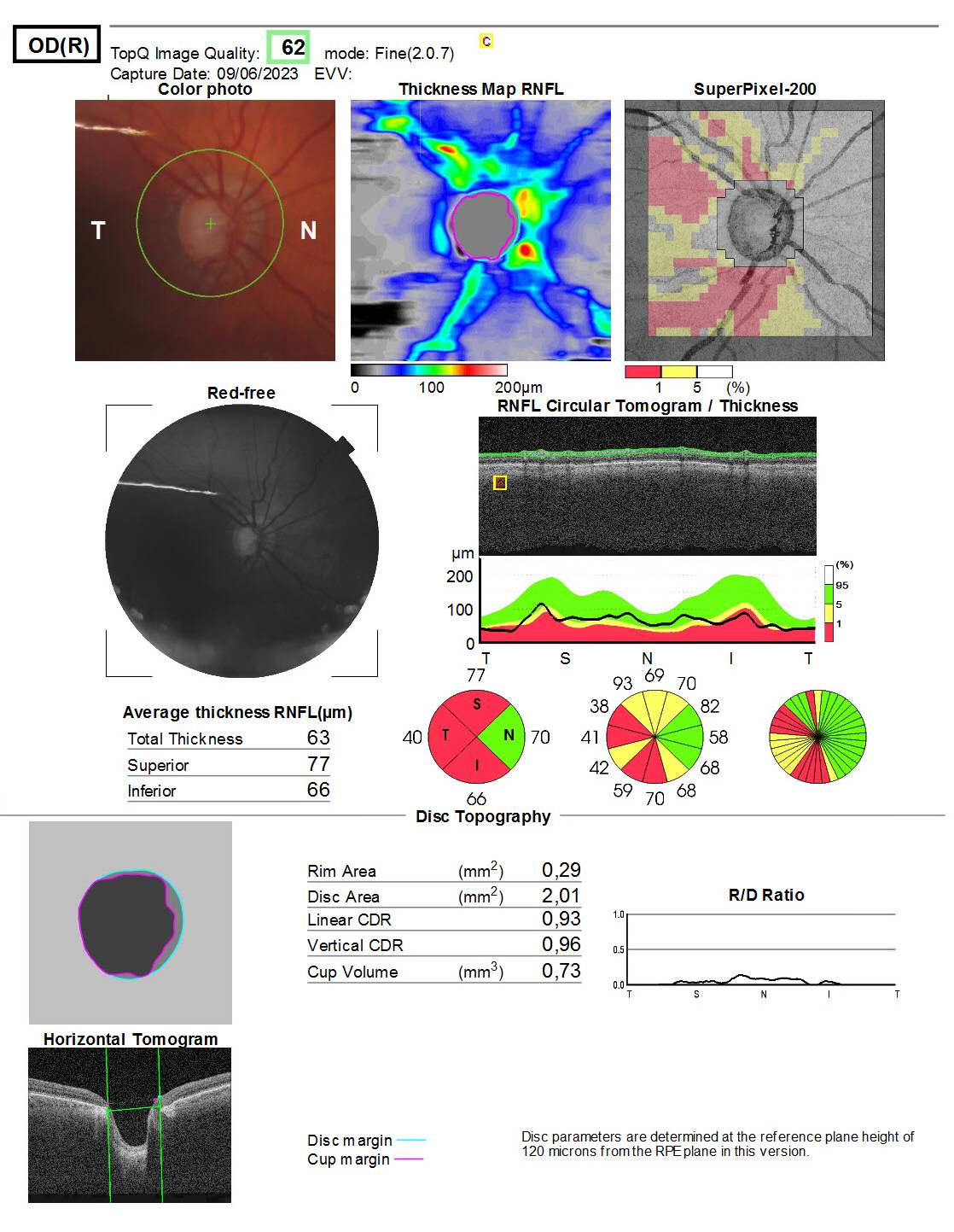 Optic disc topography, case 1, R, glaucoma