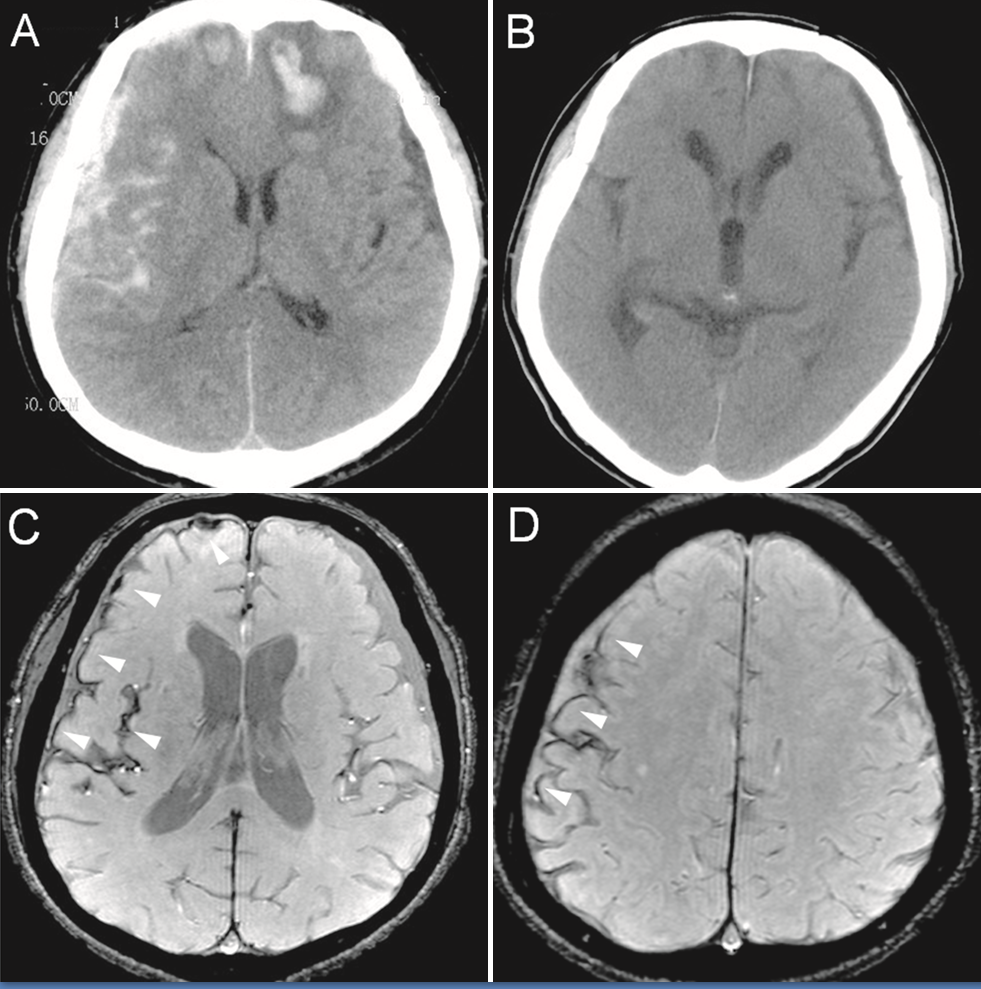 Cerebral angiography