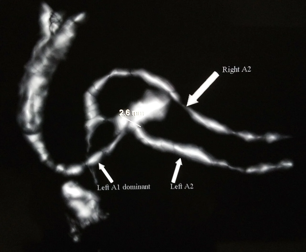 Cerebral angiography