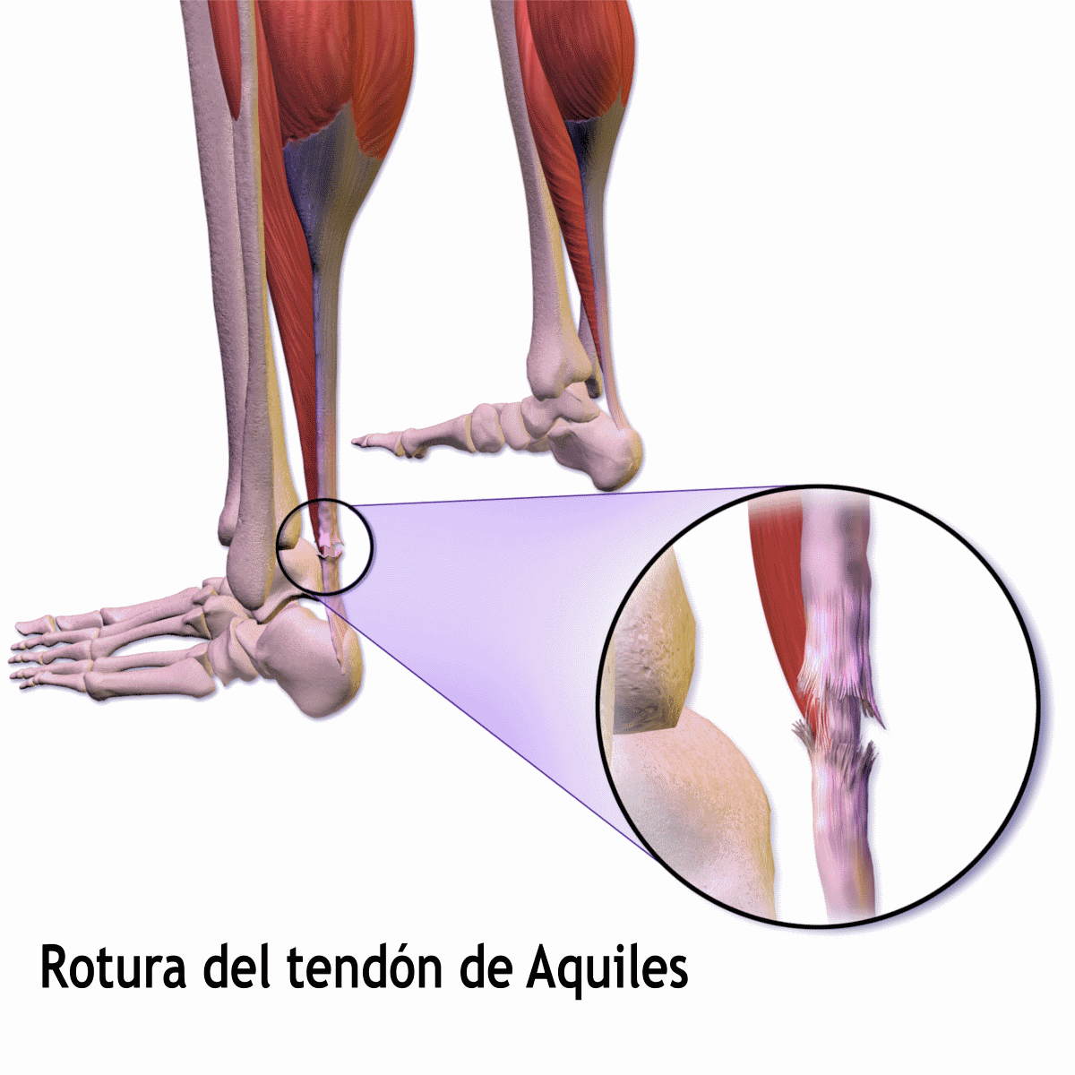 Achilles tendon rupture