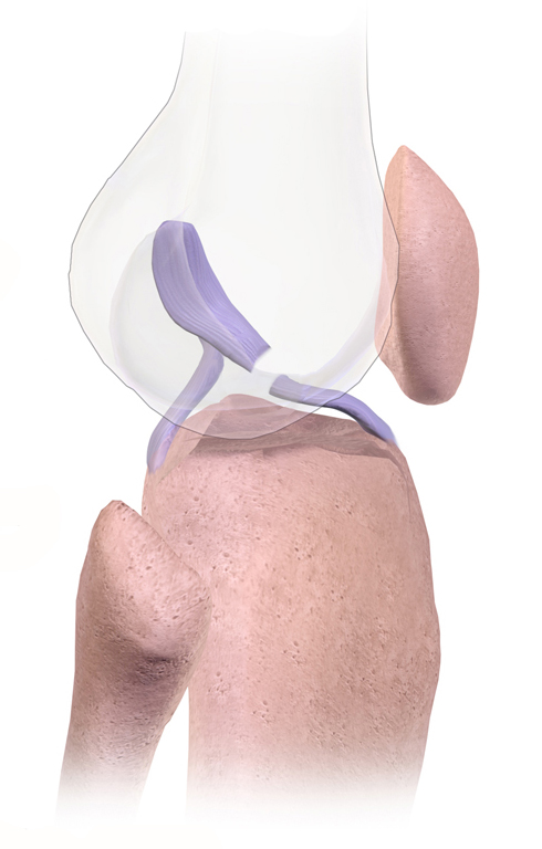 Anterior cruciate ligament injury