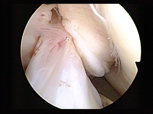 Anterior cruciate ligament injury