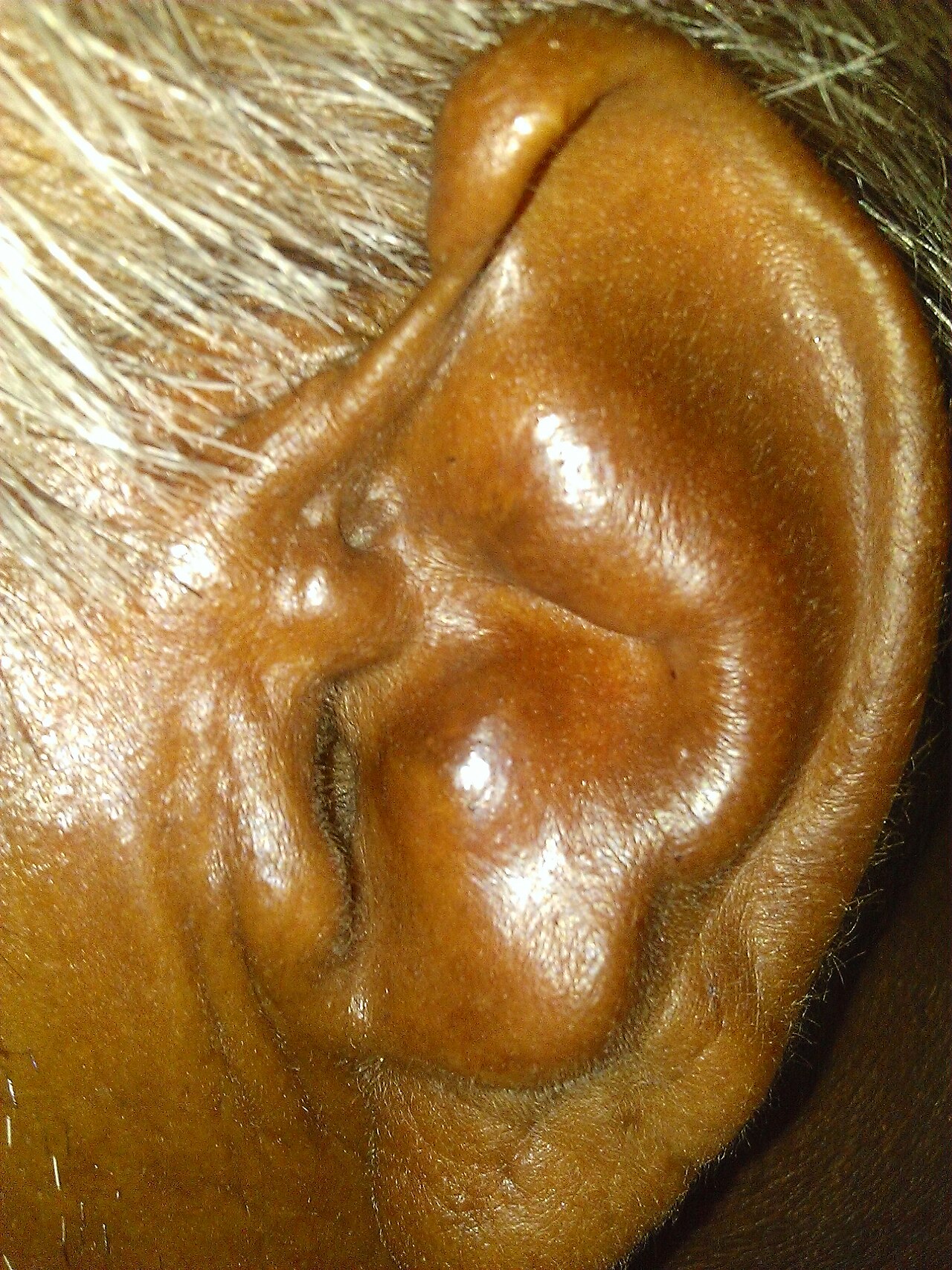 Cauliflower ear
