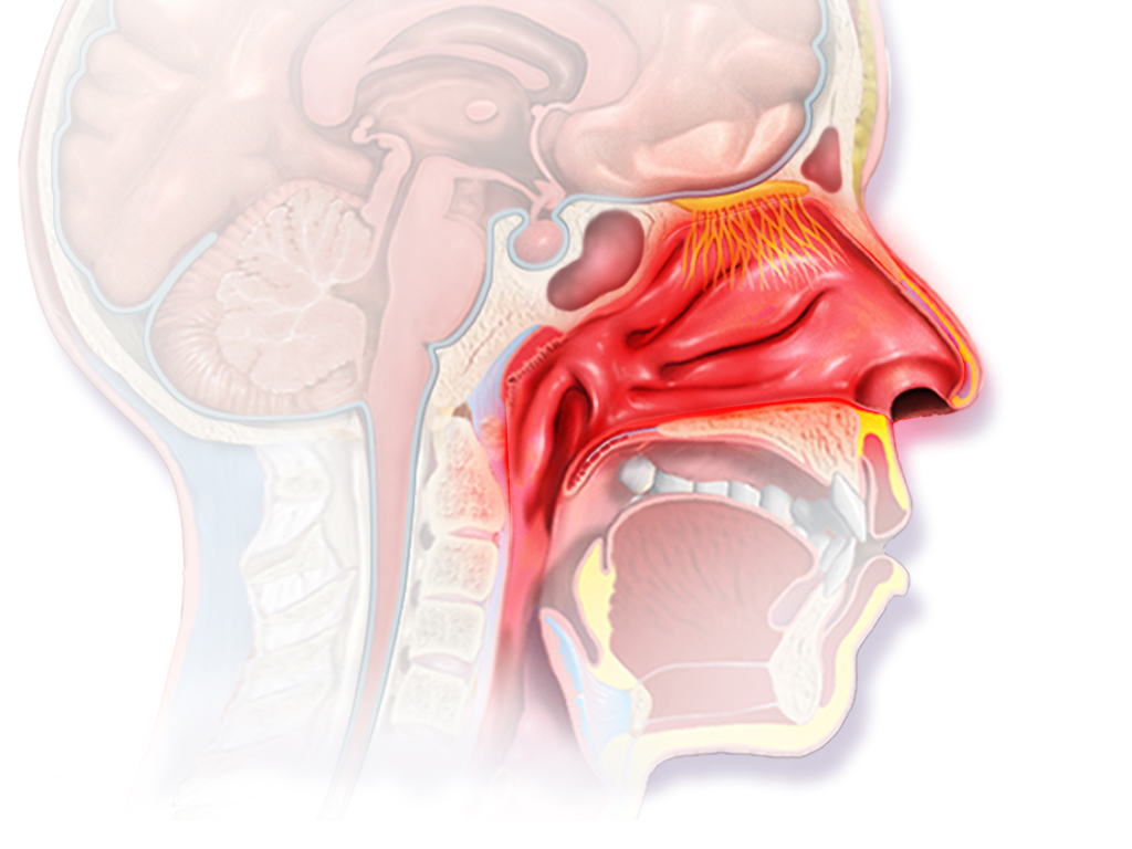 Allergic rhinitis