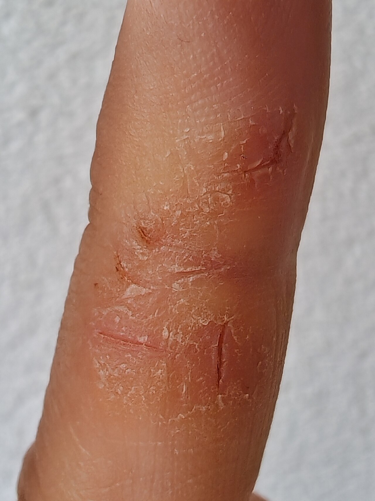 Atopic dermatitis
