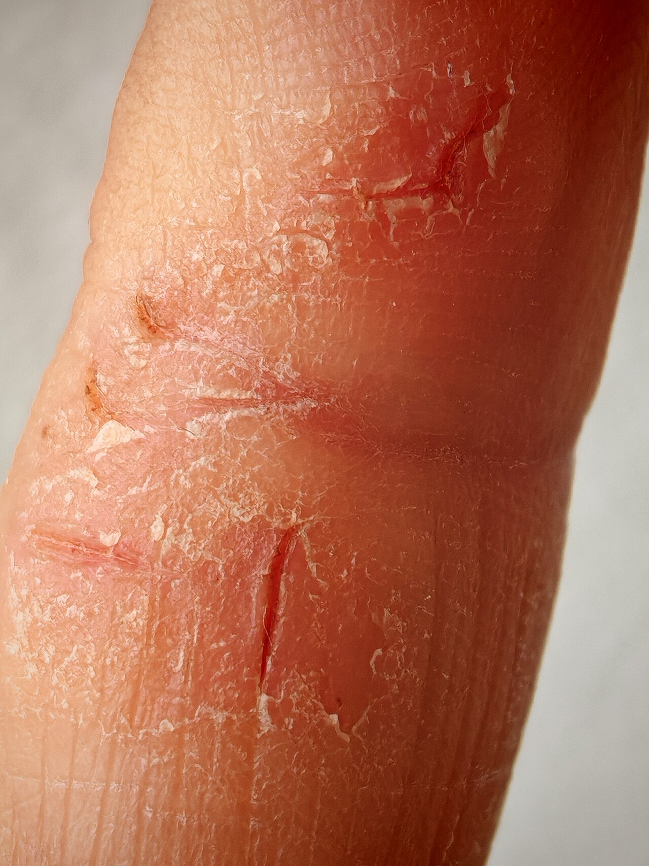 Atopic dermatitis