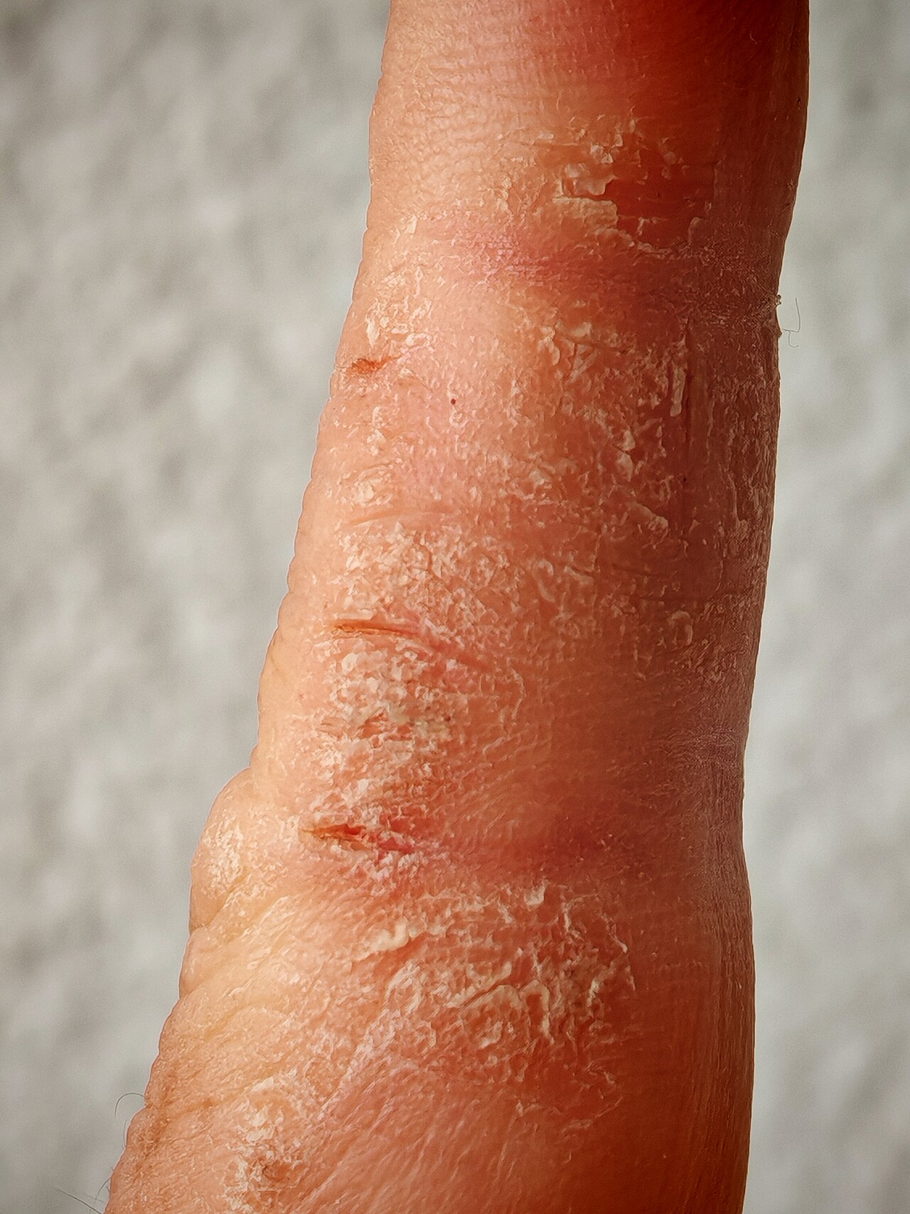 Atopic dermatitis