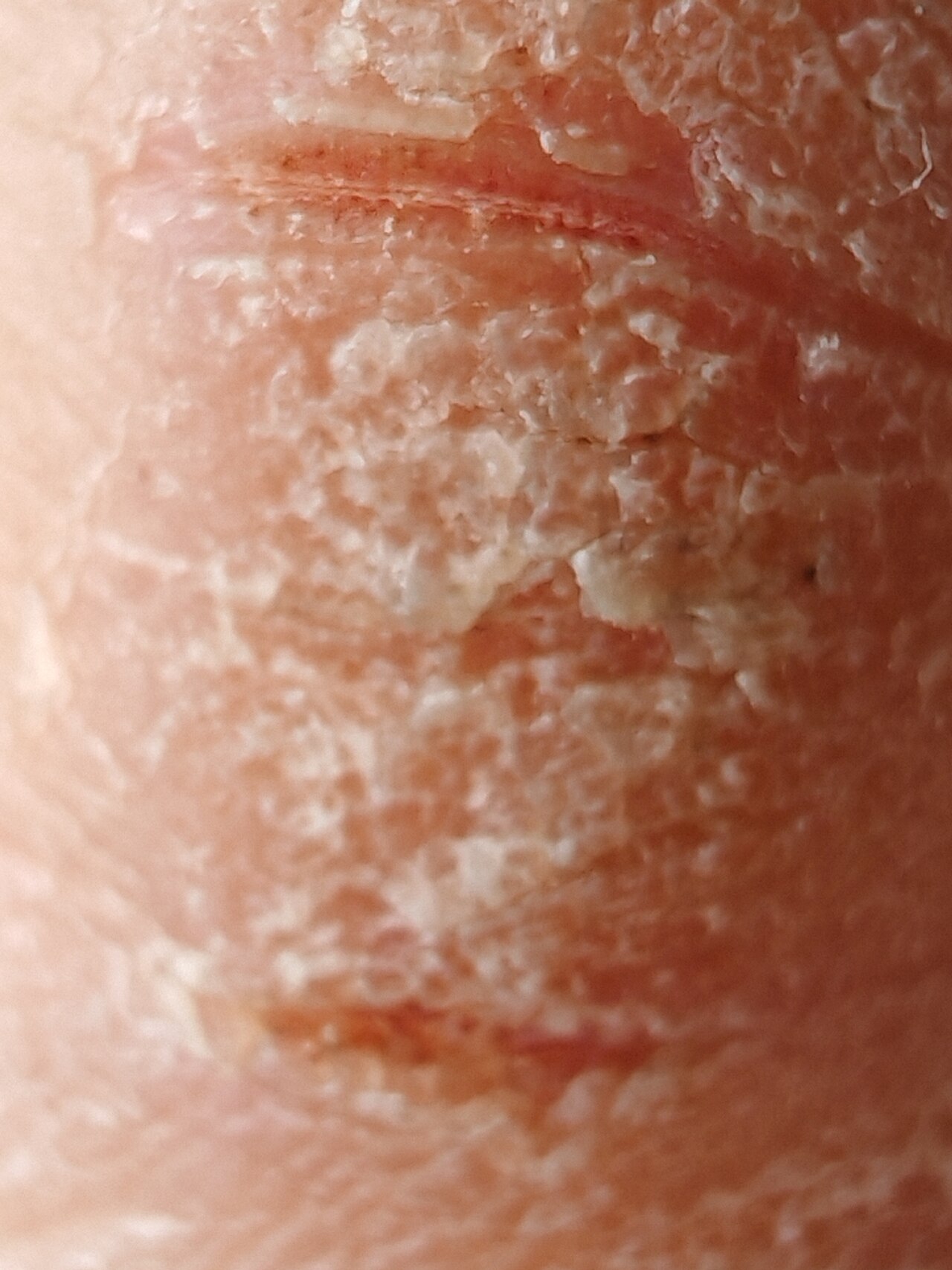 Atopic dermatitis