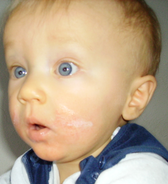 Atopic dermatitis