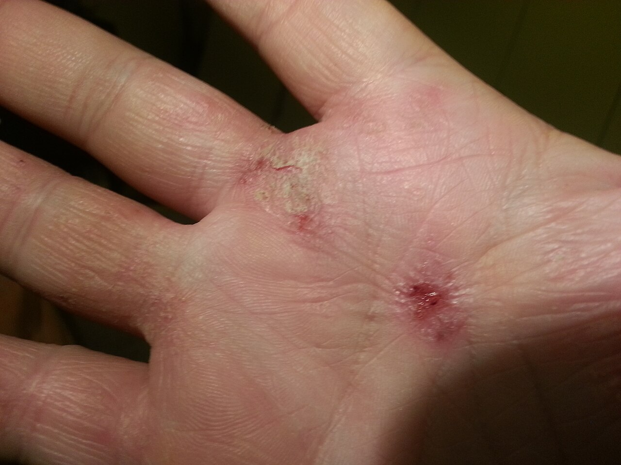 Atopic dermatitis