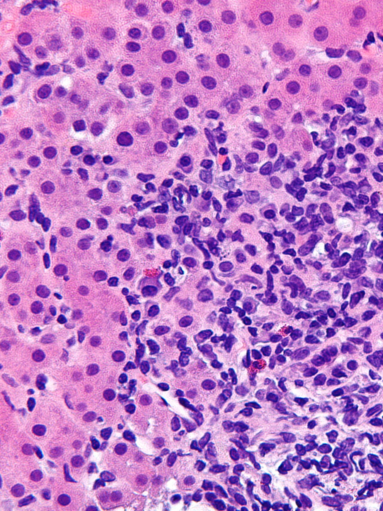 Autoimmune hepatitis