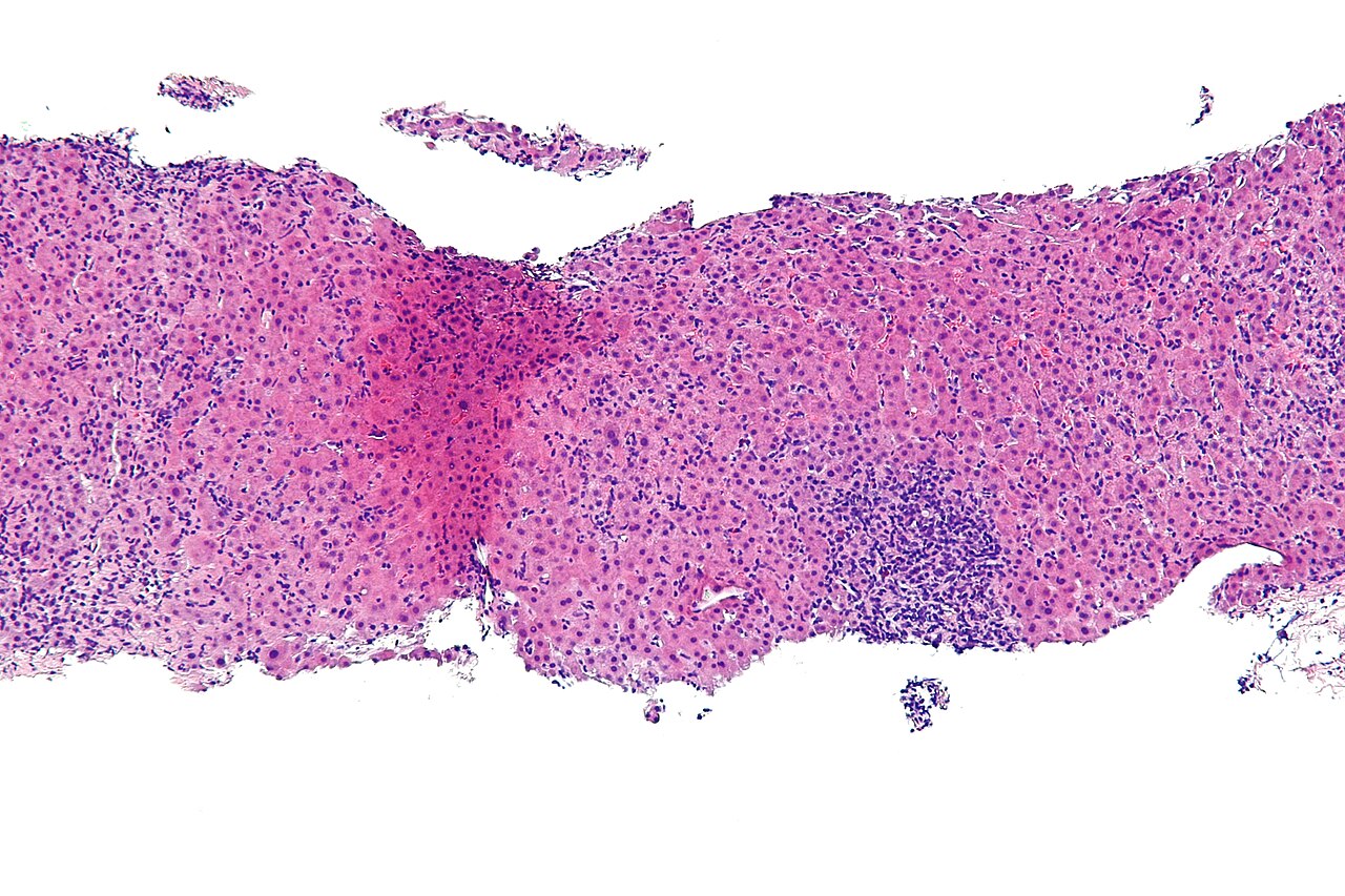 Autoimmune hepatitis