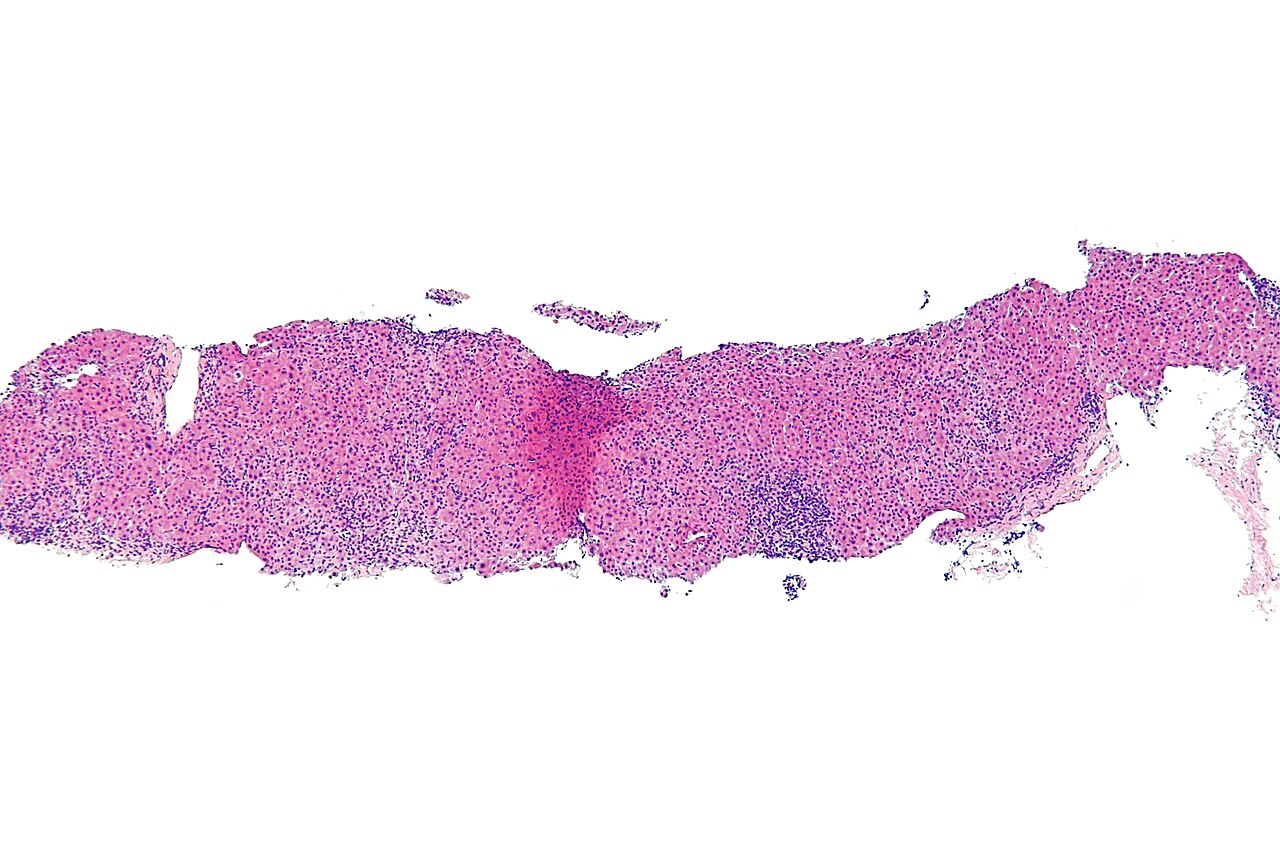 Autoimmune hepatitis