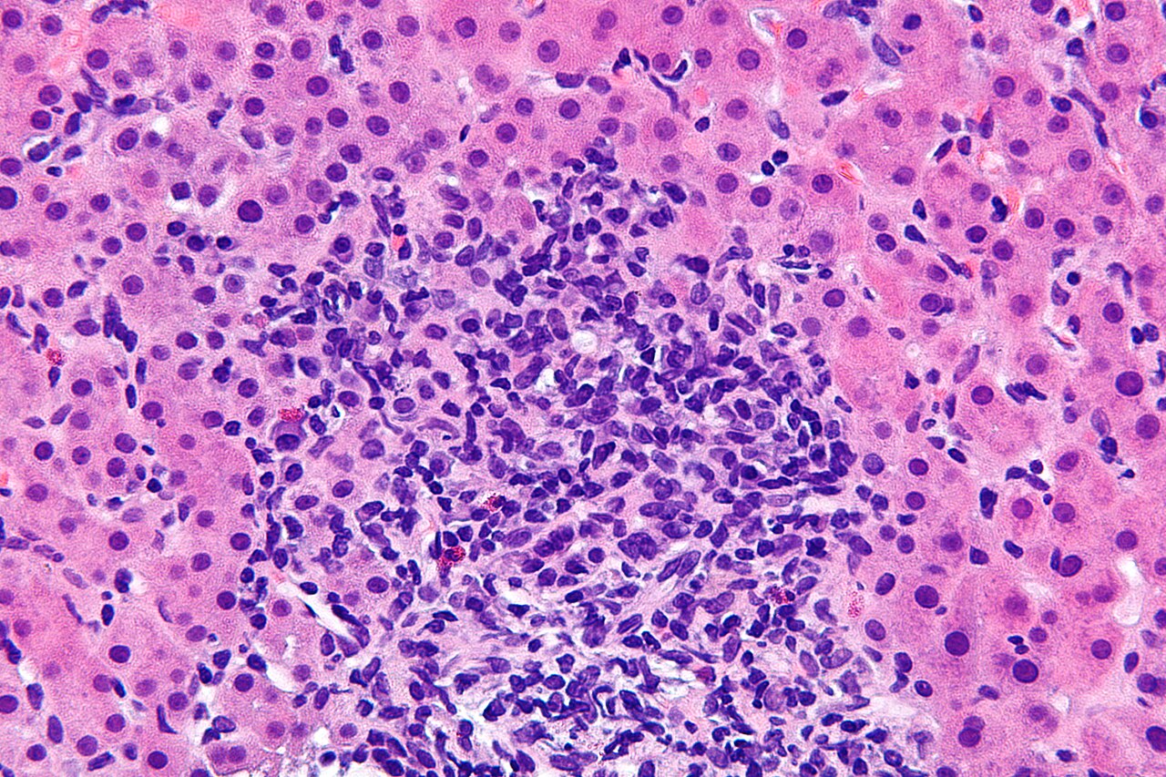 Autoimmune hepatitis