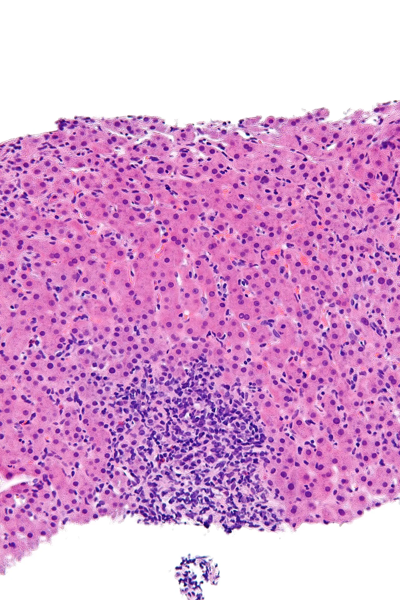 Autoimmune hepatitis