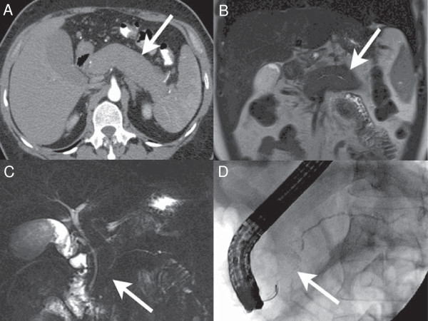 Autoimmune pancreatitis