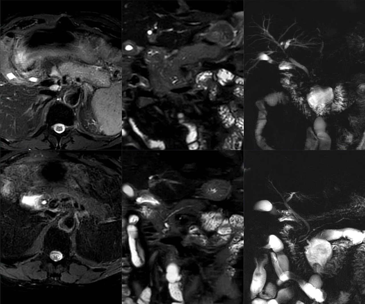 Autoimmune pancreatitis