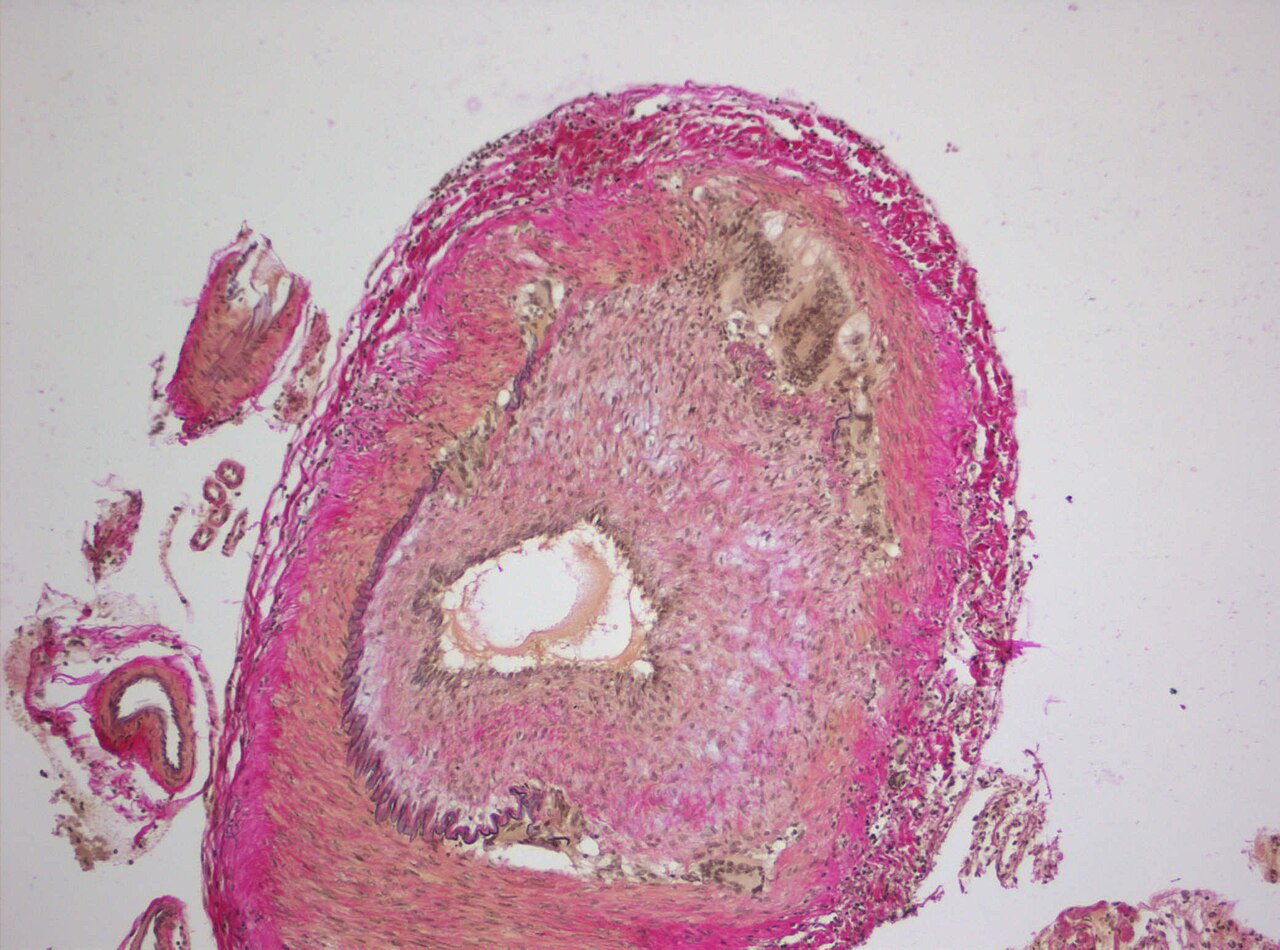 Cerebral vasculitis