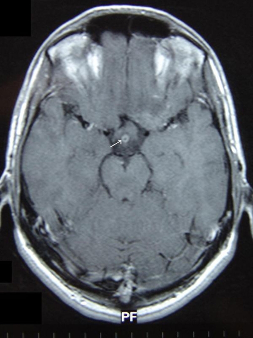 Cerebral vasculitis