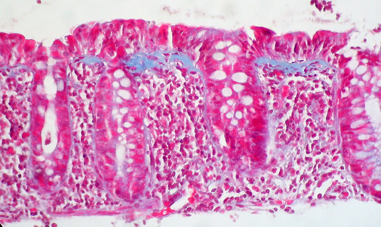 Collagenous colitis