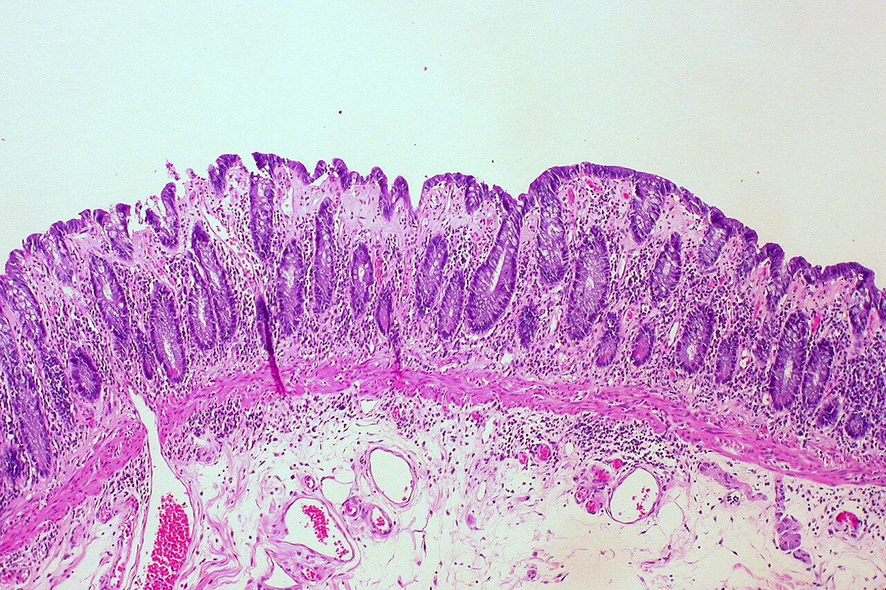 Collagenous colitis