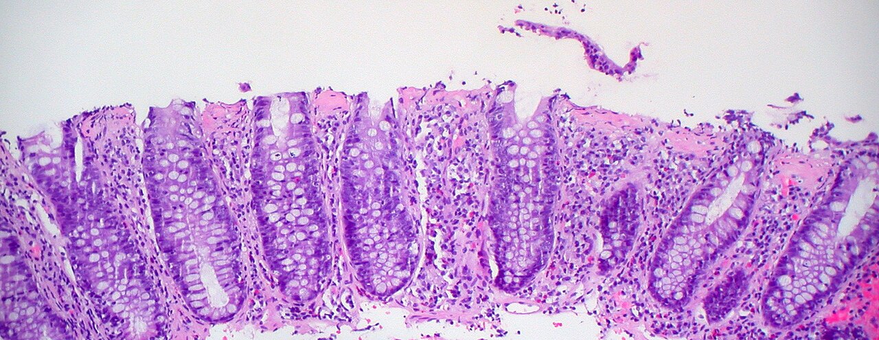 Collagenous colitis