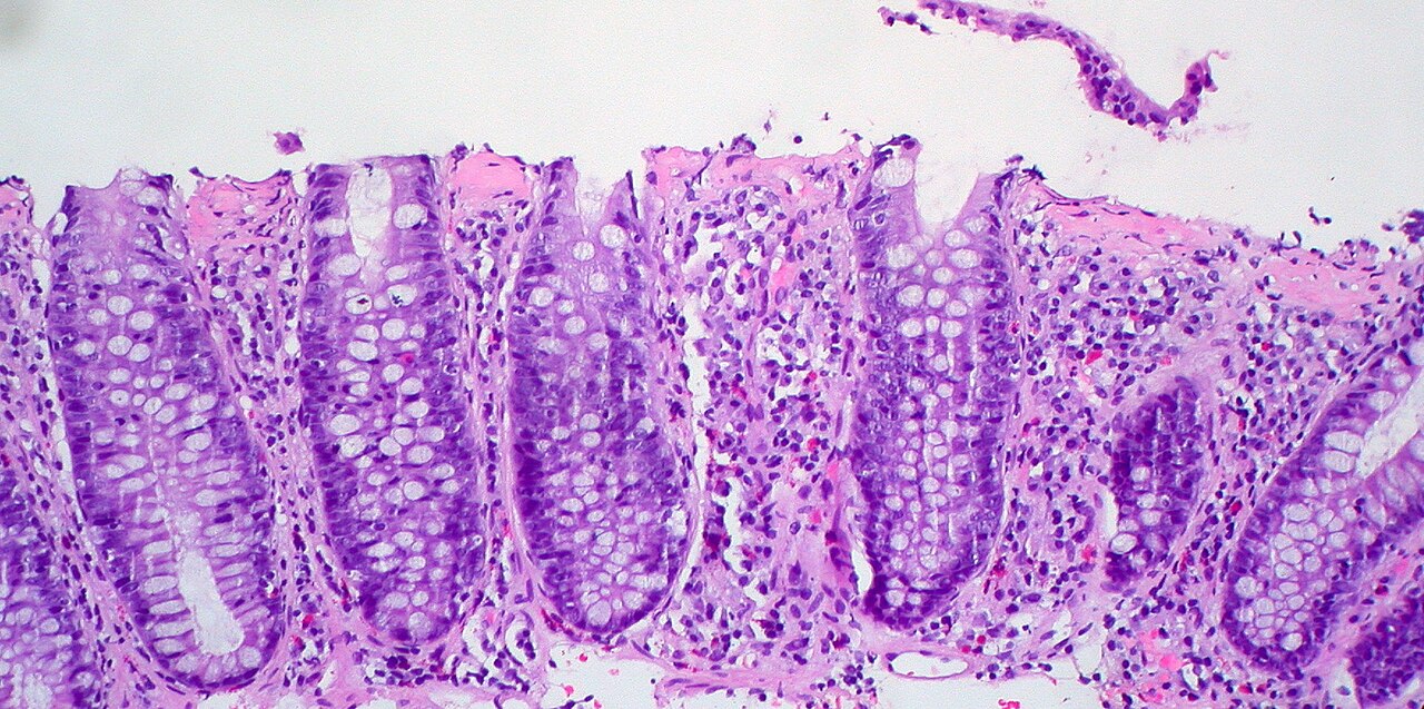 Collagenous colitis