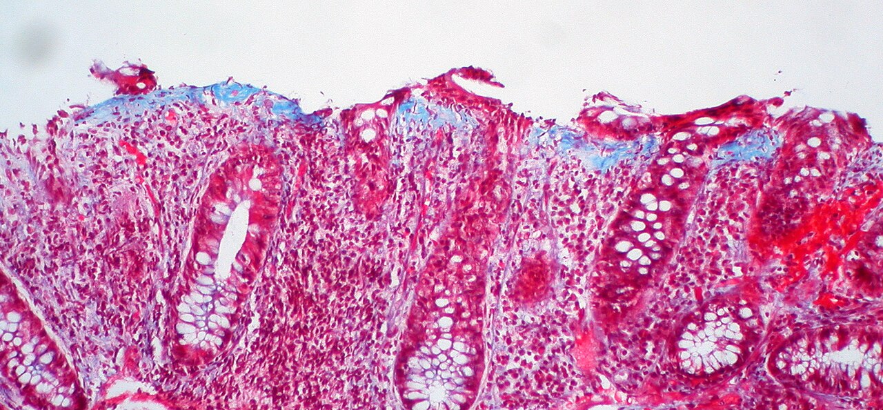 Collagenous colitis
