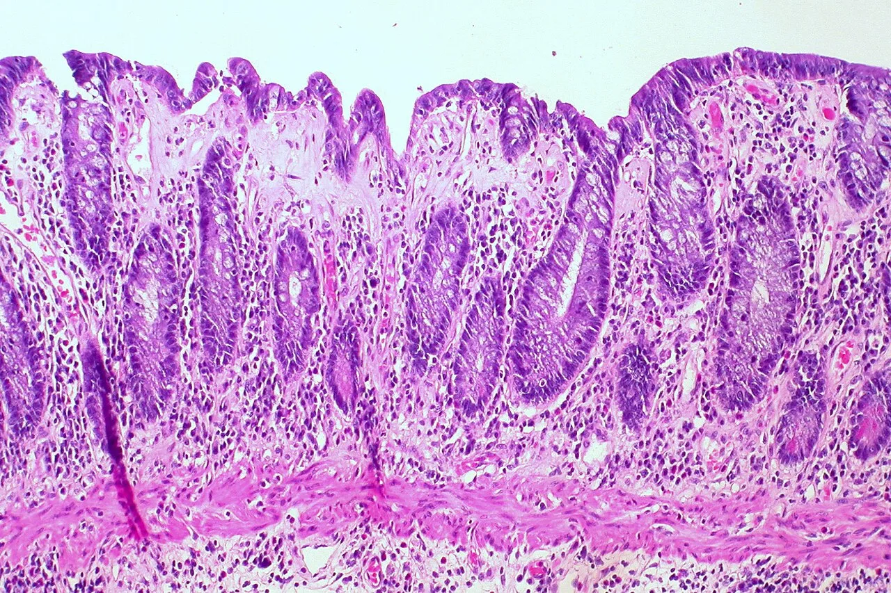 Collagenous colitis
