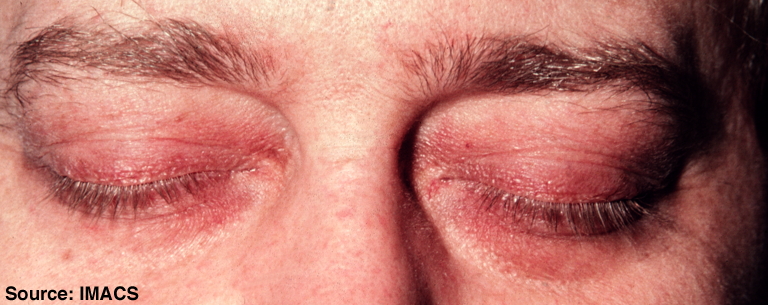 Dermatomyositis