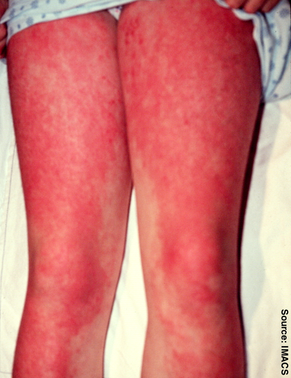 Dermatomyositis