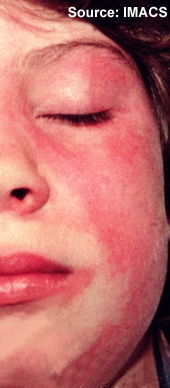 Dermatomyositis