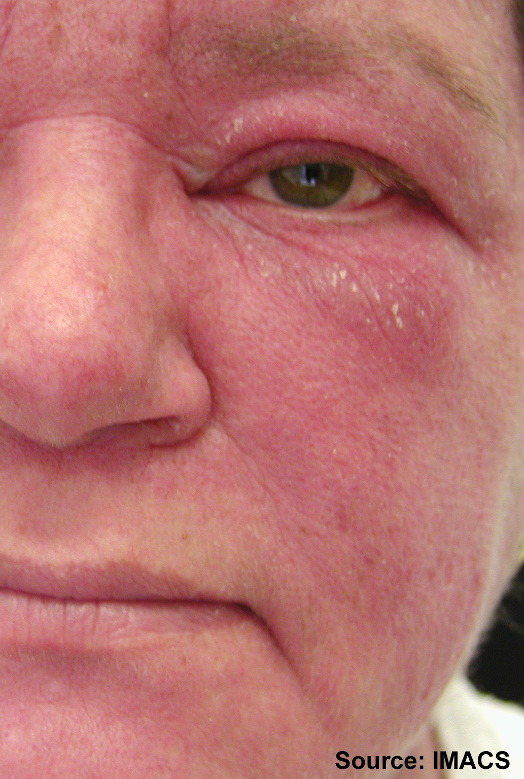 Dermatomyositis